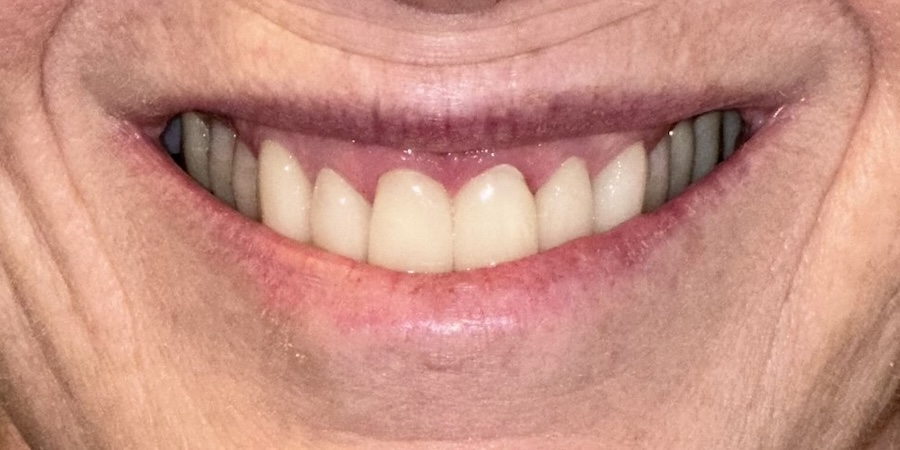 Veneers After