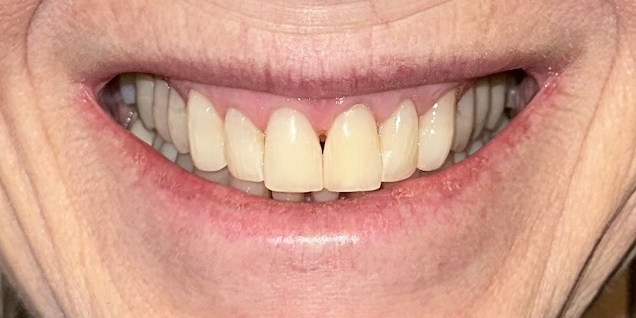 Veneers Before